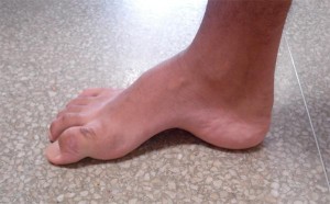 O pé cavo é uma característica da maioria dos  portadores da doença.