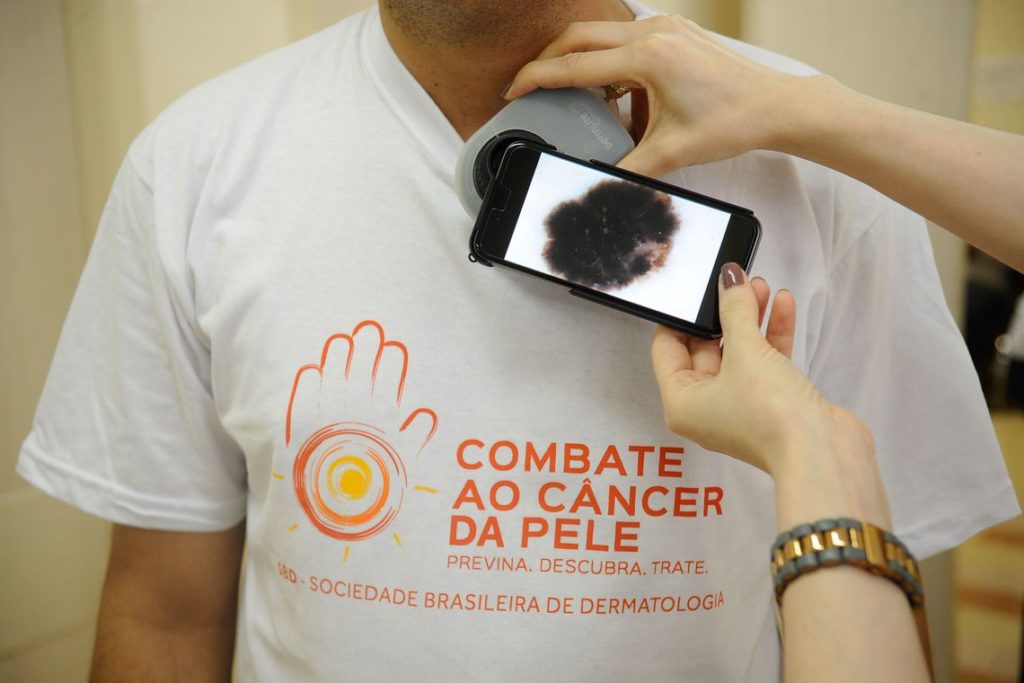 Campanha Junho Preto foca na prevenção do melanoma
