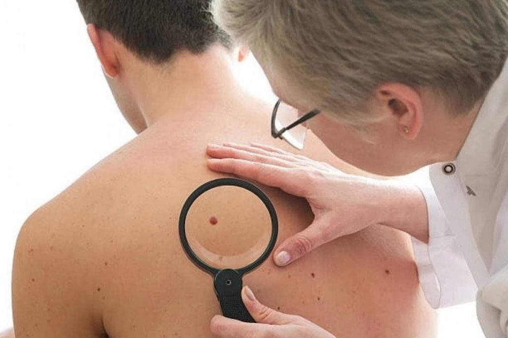Junho Preto: Campanha alerta para crescimento do melanoma no Brasil